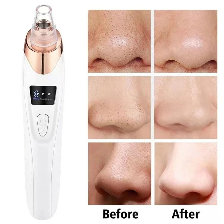 Blackhead Remover Vacuum – 5-in-1 Facial Tool