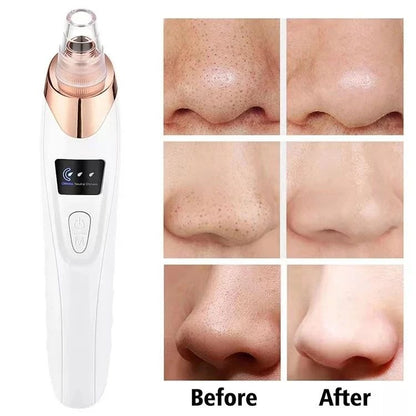 Blackhead Remover Vacuum – 5-in-1 Facial Tool
